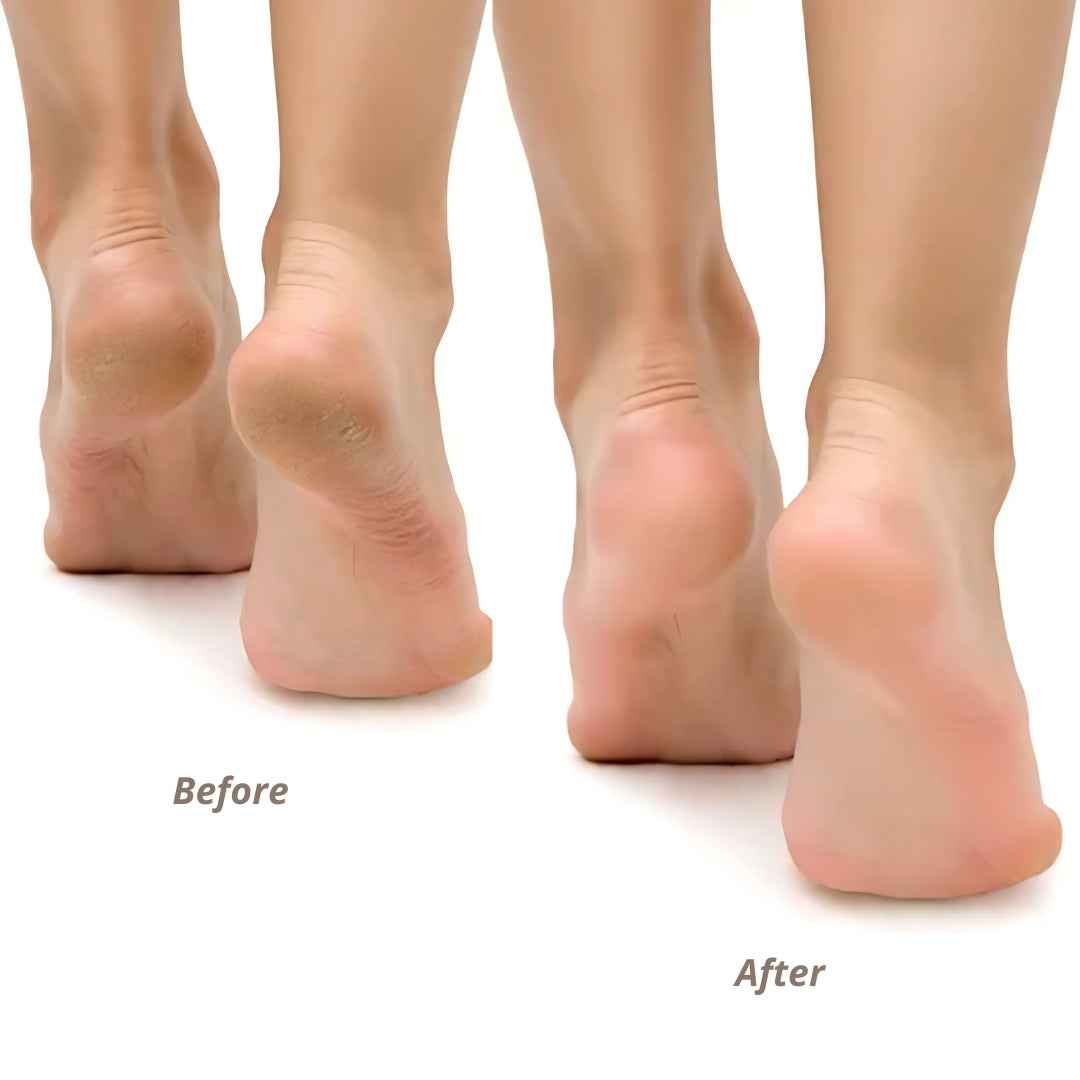 DAHR Electric Pedi Callous Remover